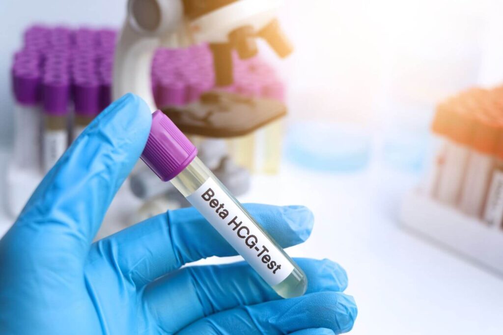 Hand wearing a blue sterile glove holds a vial of urine with 'Beta HCG Test' label on it