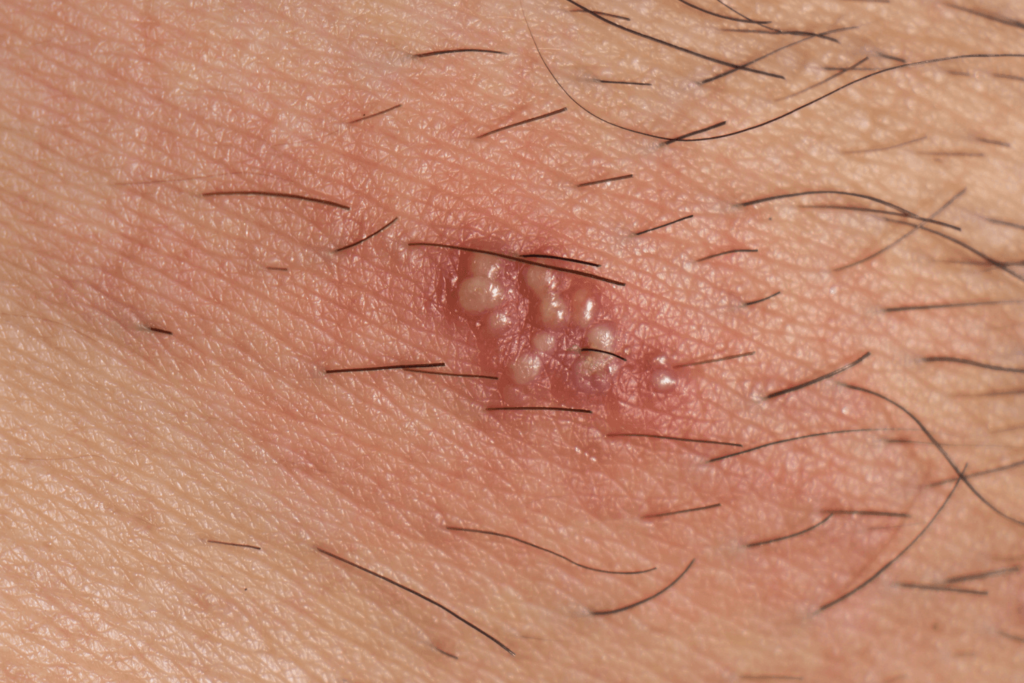 herpes outbreak on skin